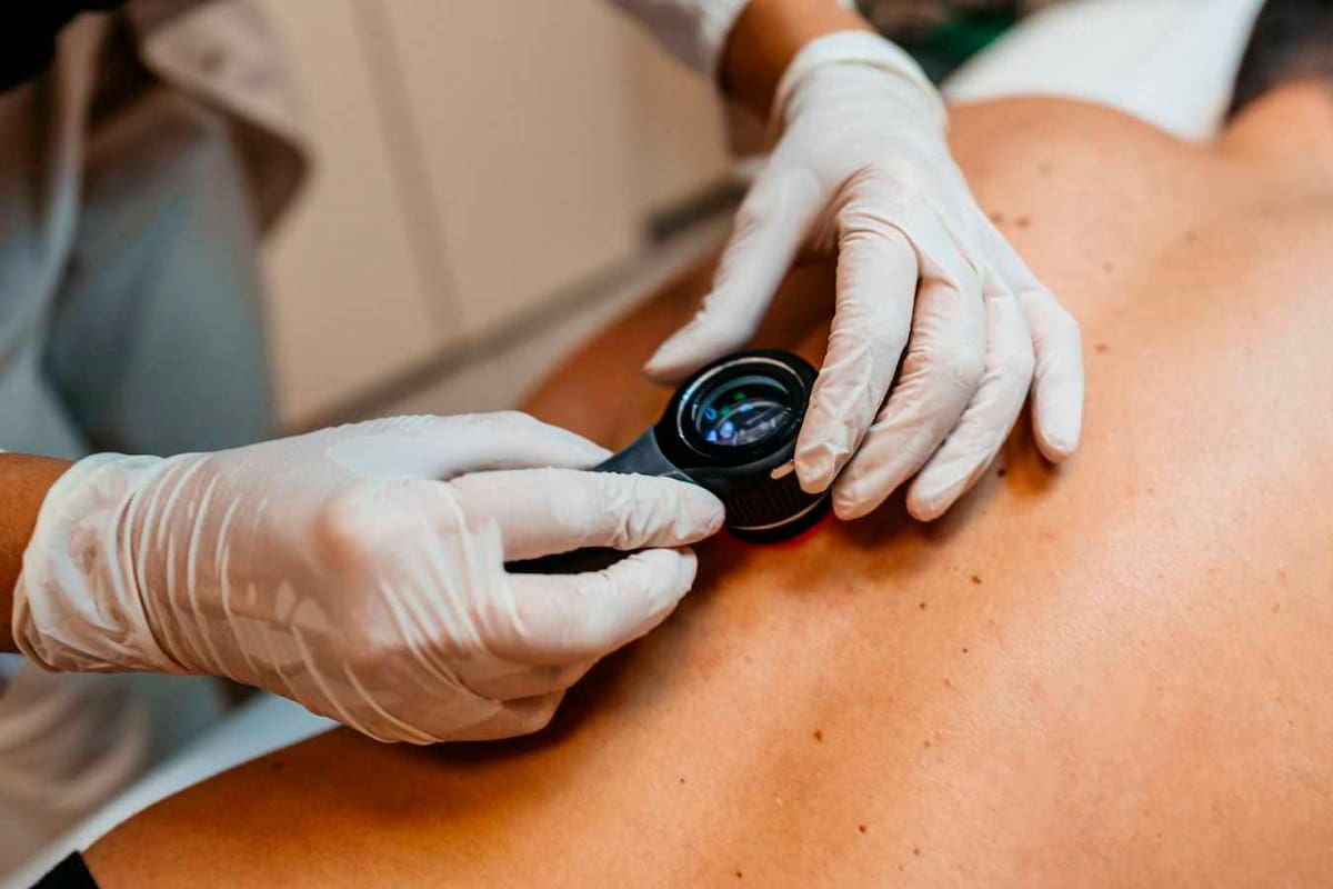 Combinar dos fármacos alarga la vida de los pacientes con melanoma ...