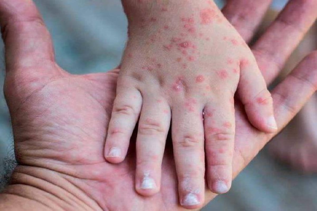 La Secretaría de Salud de Santander descartó la presencia de la viruela del mono en Barrancabermeja. | Archivo / VANGUARDIA