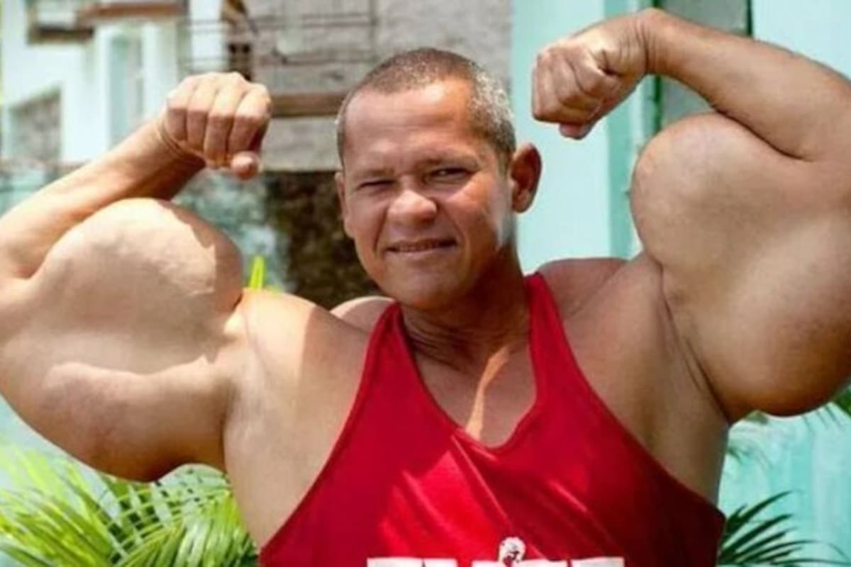 Murió el 'Popeye' brasileño, el hombre que se inyectó aceite en los brazos durante más de 30 años.