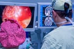 Neurocirugía: así se usan la exoscopia 3D y la neuronavegación en cirugías de alta complejidad