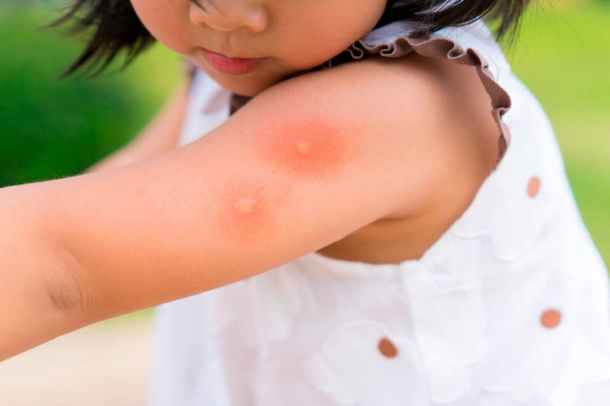 Las picaduras de abejas y avispas son conocidas por su dolor inmediato y la posibilidad de reacciones alérgicas graves.