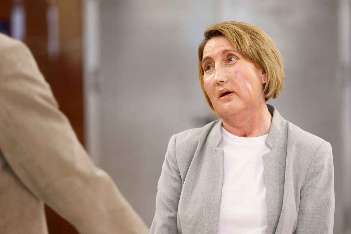 Carmen, la primera paciente en recibir un trasplante de cara de una donante que recibió una eutanasia, posa para los medios de comunicación antes de la rueda de prensa que se ha celebrado en el Hospital Vall d'Hebron de Barcelona para explicar el procedimiento. EFE/Quique García