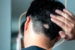 Qué es la alopecia areata y por qué requiere atención médica