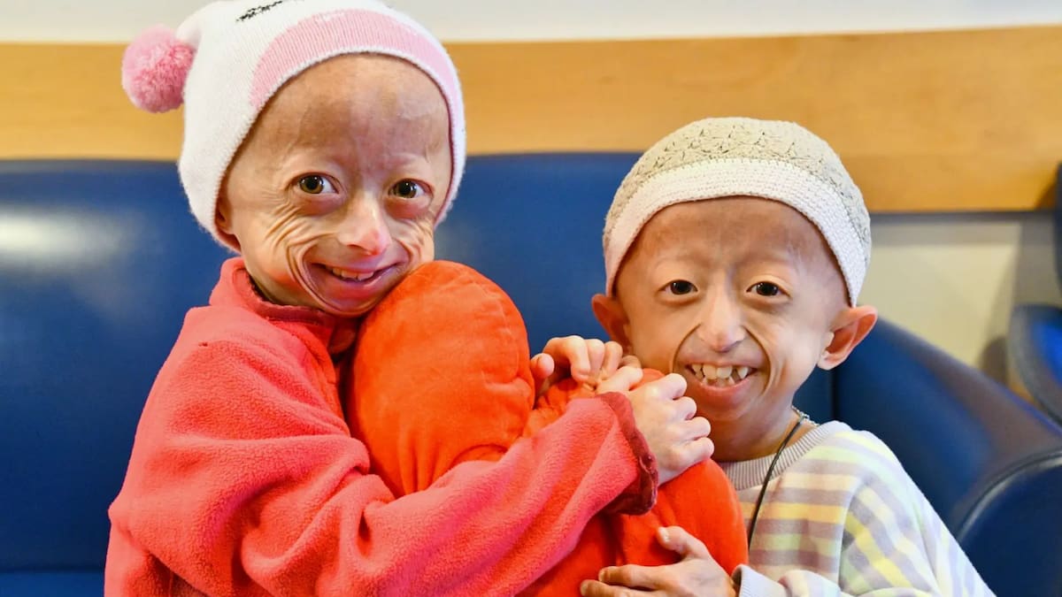 Qué es la progeria, la extraña enfermedad que padecía Sammy Basso. Foto tomada de redes sociales/VANGUARDIA