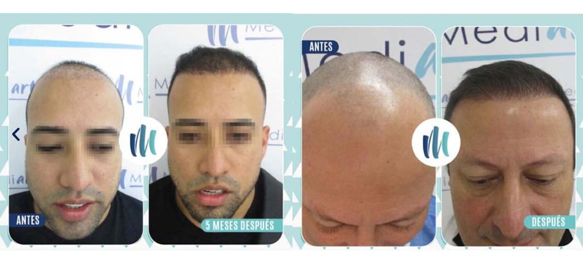 ¿Qué hay detrás del auge de los implantes capilares entre los famosos?