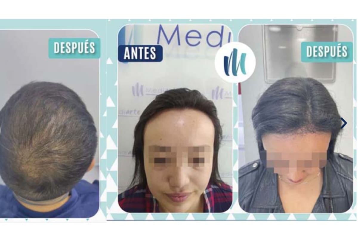 ¿Qué hay detrás del auge de los implantes capilares entre los famosos?
