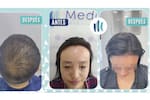 ¿Qué hay detrás del auge de los implantes capilares entre los famosos?