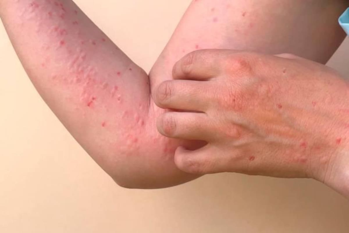 Las autoridades de salud en Santander entregaron recomendaciones para prevenir contagios por viruela del mono. (Foto: Archivo / VANGUARDIA)