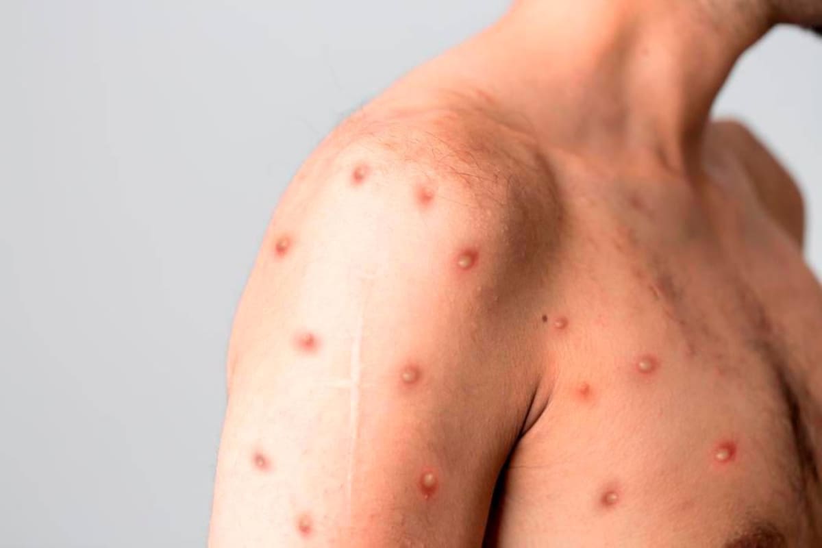 Santander alerta más contagios por viruela del mono: encienden alarmas
