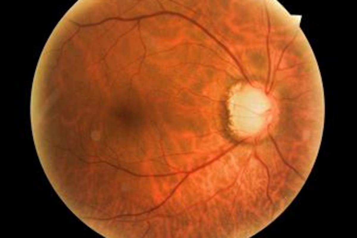 Nervio óptico afectado por un glaucoma avanzado.