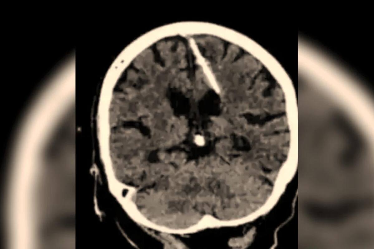 Este extraordinario caso sirve como un recordatorio de la resiliencia del cuerpo humano y la importancia de la vigilancia médica constante, incluso en situaciones aparentemente inusuales. Fotos tomadas de redes sociales/VANGUARDIA