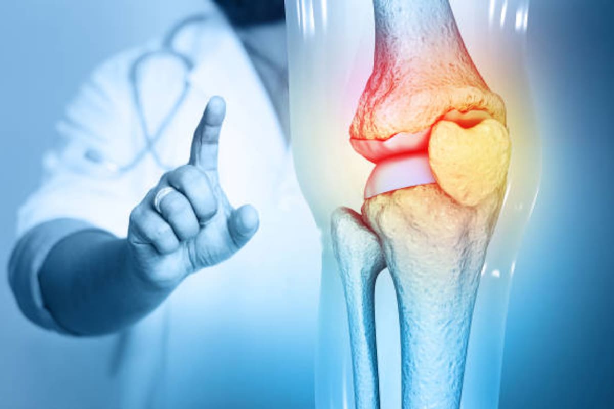 Un tumor óseo es el crecimiento anormal de células en el tejido de un hueso. Pueden ser benignos (no cancerosos, más comunes y no se extienden) o malignos (cancerosos, como el osteosarcoma, que pueden invadir tejidos y dar metástasis). Muchos no causan molestias al principio, pero otros generan dolor o debilitan el hueso.