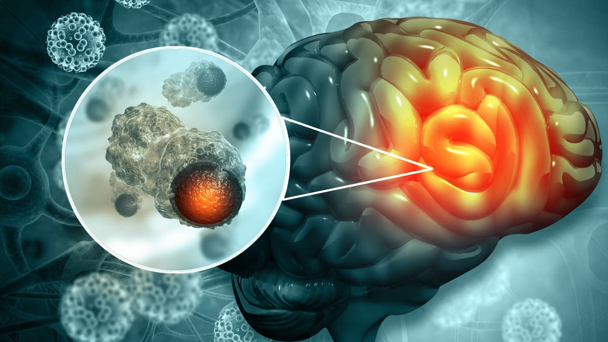 Tumores cerebrales: qué son, diagnóstico y tratamiento.