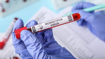 Se confirma segundo caso de mpox clado Ib en Colombia: se activó cerco epidemiológico de pasajero que llegó de Madrid a Bogotá