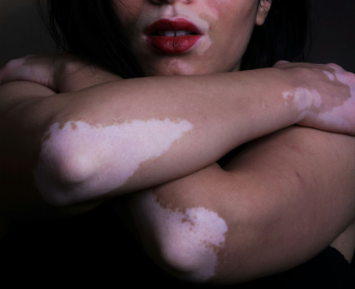 El vitiligo afecta a millones de personas en el mundo, pero su mayor batalla no ocurre en la piel, sino en la salud mental. La ansiedad, el aislamiento y la depresión son las secuelas invisibles de los estigmas sociales