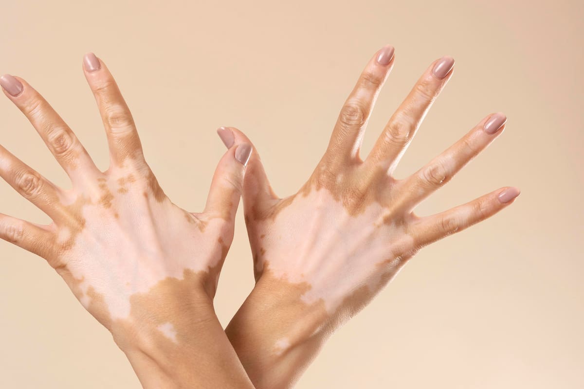 El vitiligo se genera por la pérdida de melanocitos en la piel. Especialistas recuerdan que el apoyo psicológico es tan importante como el dermatológico. (Foto: Getty Images).