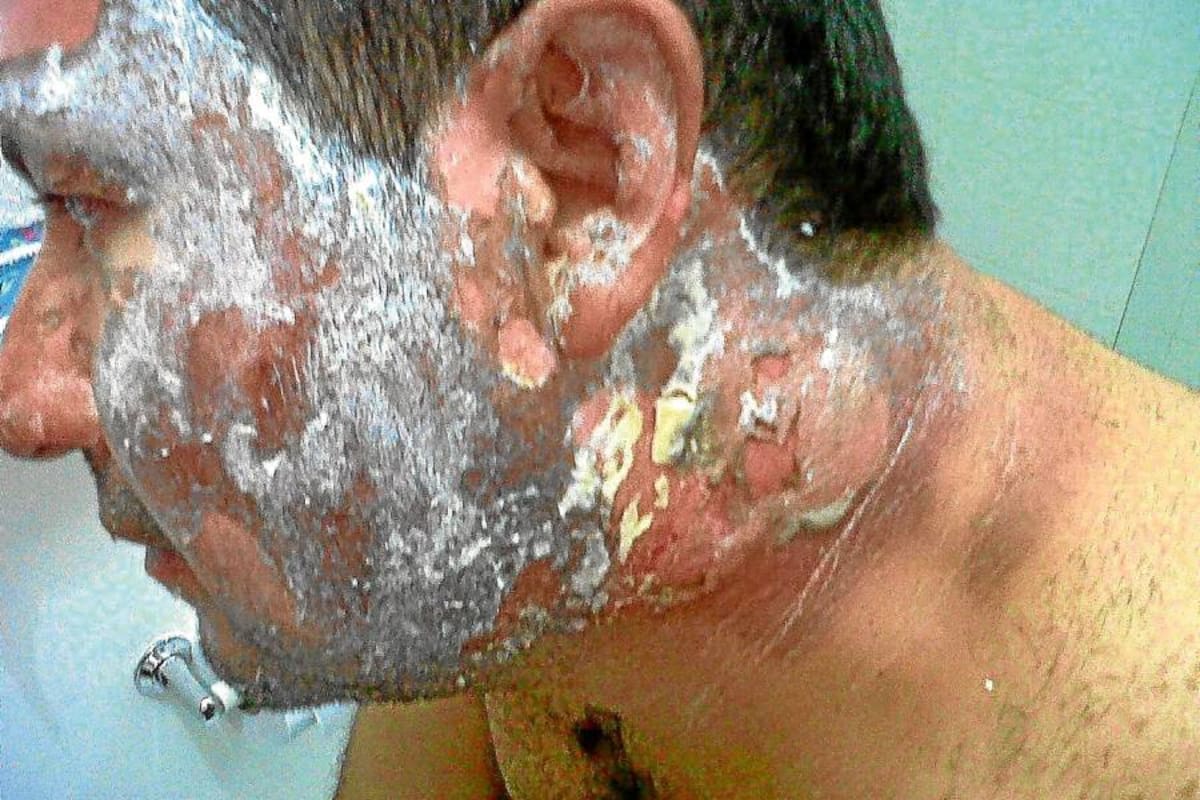 El padre de Jacobo fue uno de los más afectados. Sus manos, cara y cuello resultaron seriamente afectadas. (Foto: Suministrada/VANGUARDIA LIBERAL)
