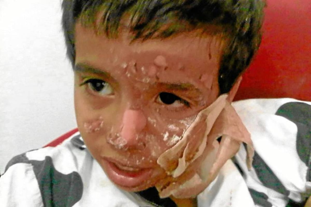 El pequeño Jacobo sufrió quemaduras en su cara que debieron ser tratadas por especialistas. (Foto: Suministrada/VANGUARDIA LIBERAL)