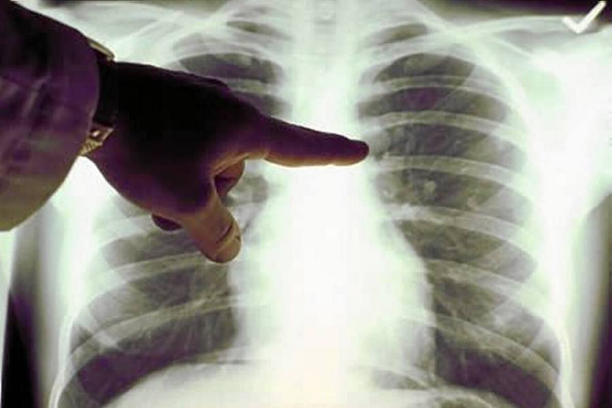 El vínculo desatendido entre la tos y el cáncer de pulmón (Foto: TOMADA DE INTERNET)