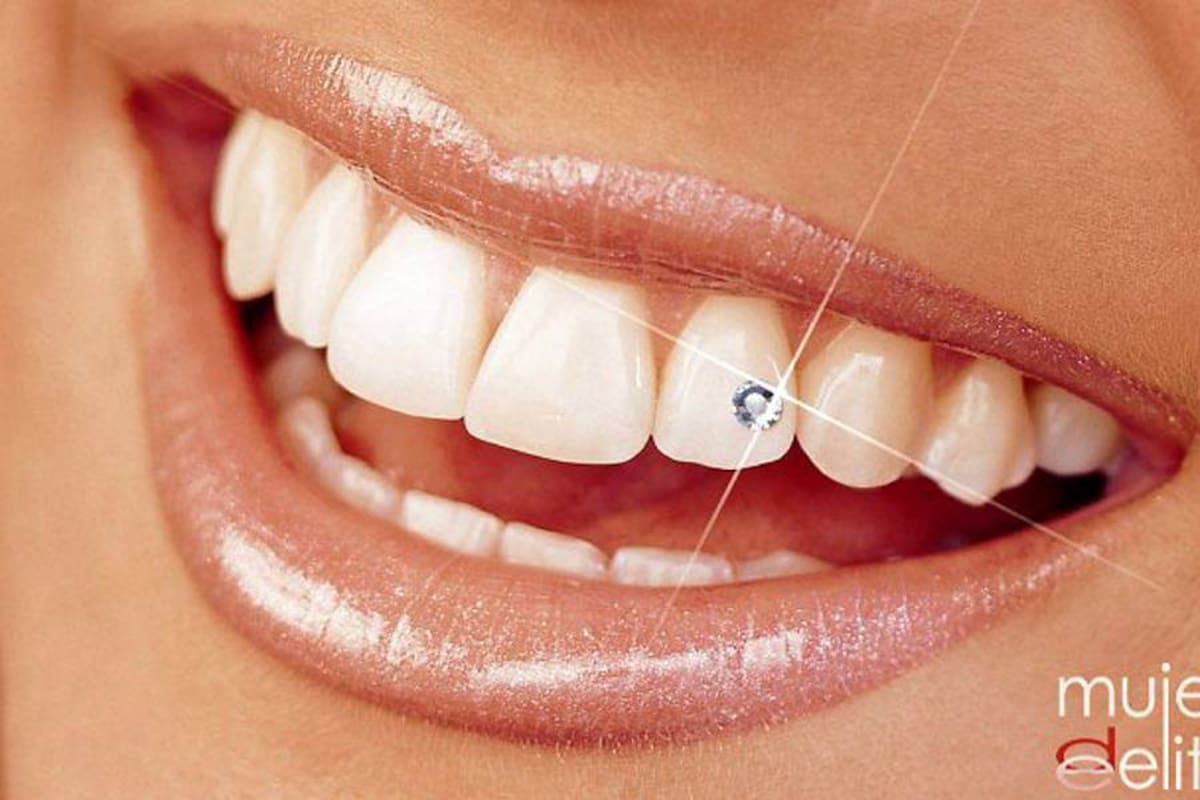 El “Bling Bling”, la última tendencia en joyería dental (Foto: Tomado de Internet/VANGUARDIA LIBERAL)