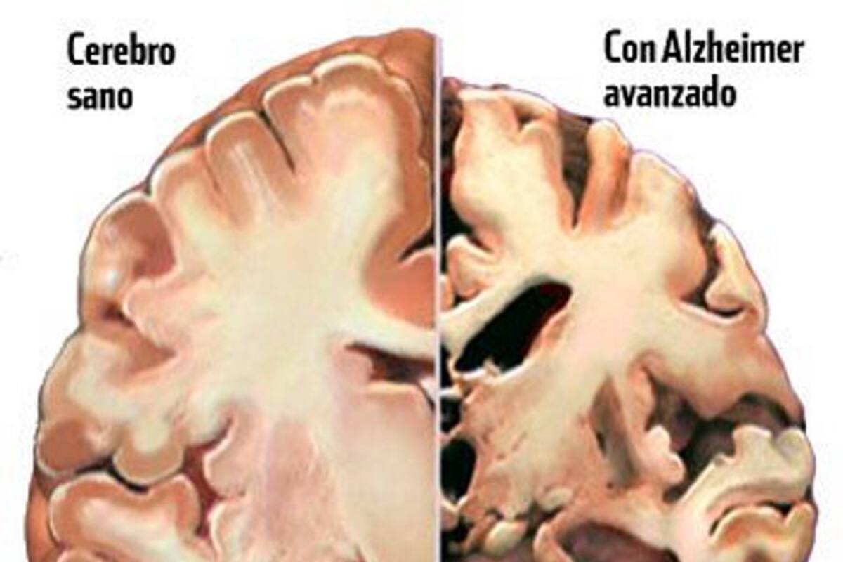 Químicos alemanes presentan método de diagnóstico precoz de Alzheimer (Foto: Tomada de internet/ VANGUARDIA LIBERAL)