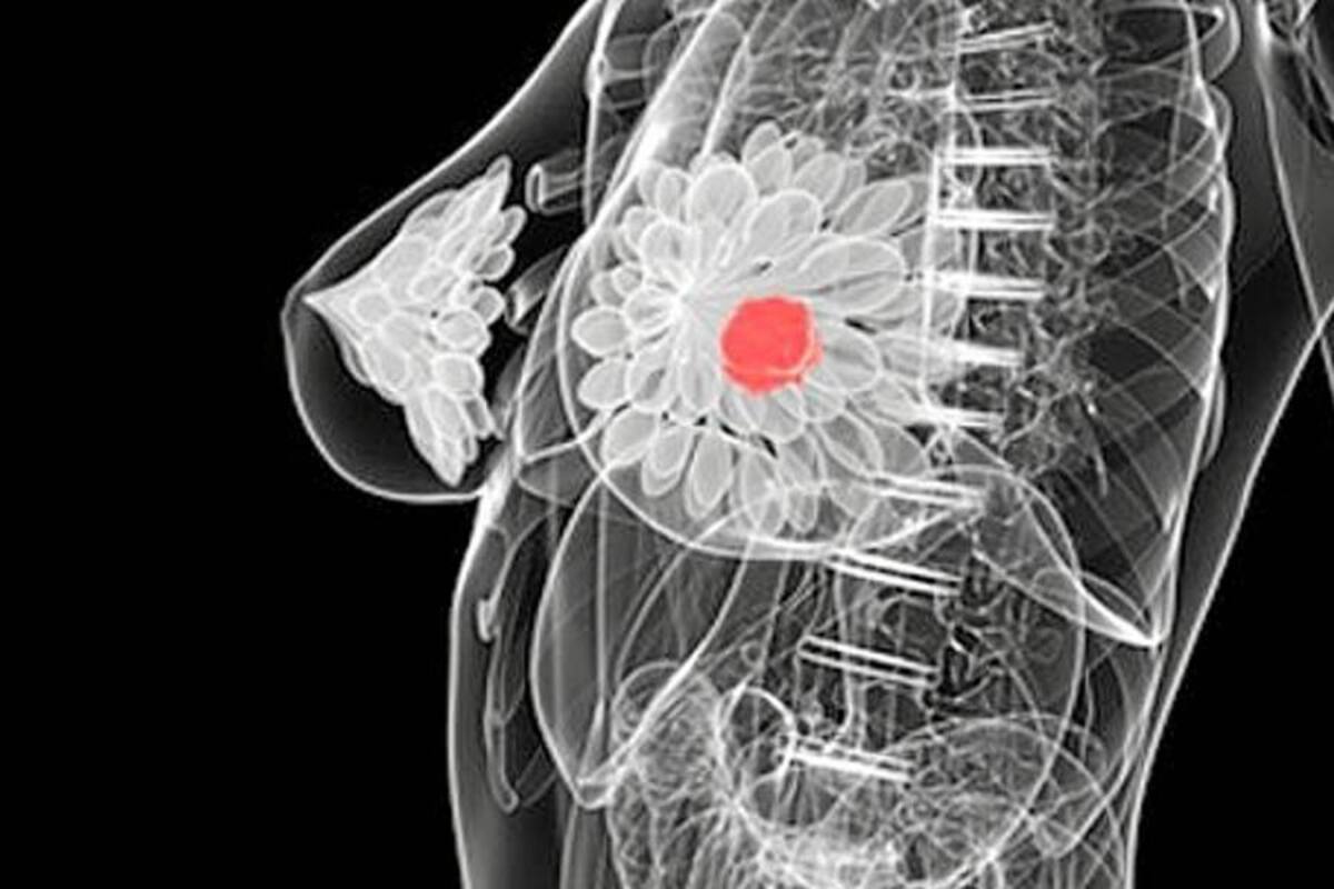 Nuevo tratamiento contra cáncer de mama avanzando aumenta la supervivencia (Foto: Tomado de Internet/ VANGUARDIA LIBERAL)