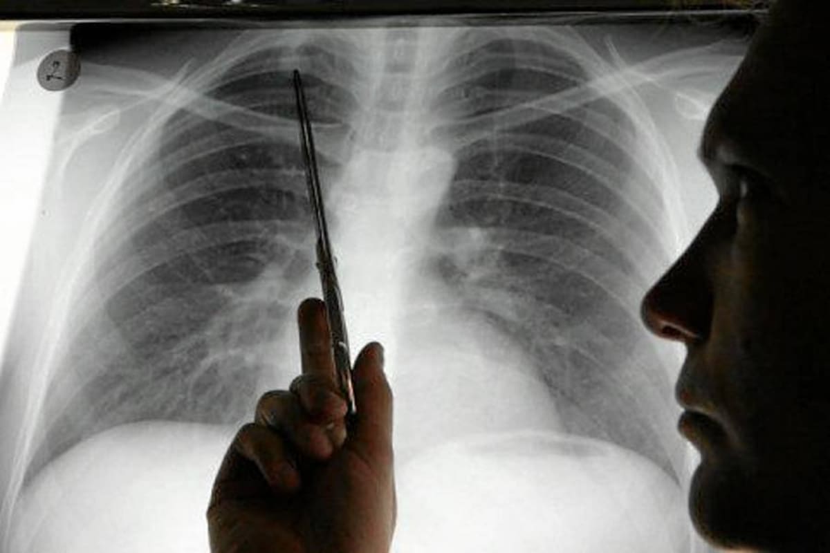 Avance en la identificación de células causantes del cáncer de pulmón (Foto: Tomada de Internet/ VANGUARDIA LIBERAL)