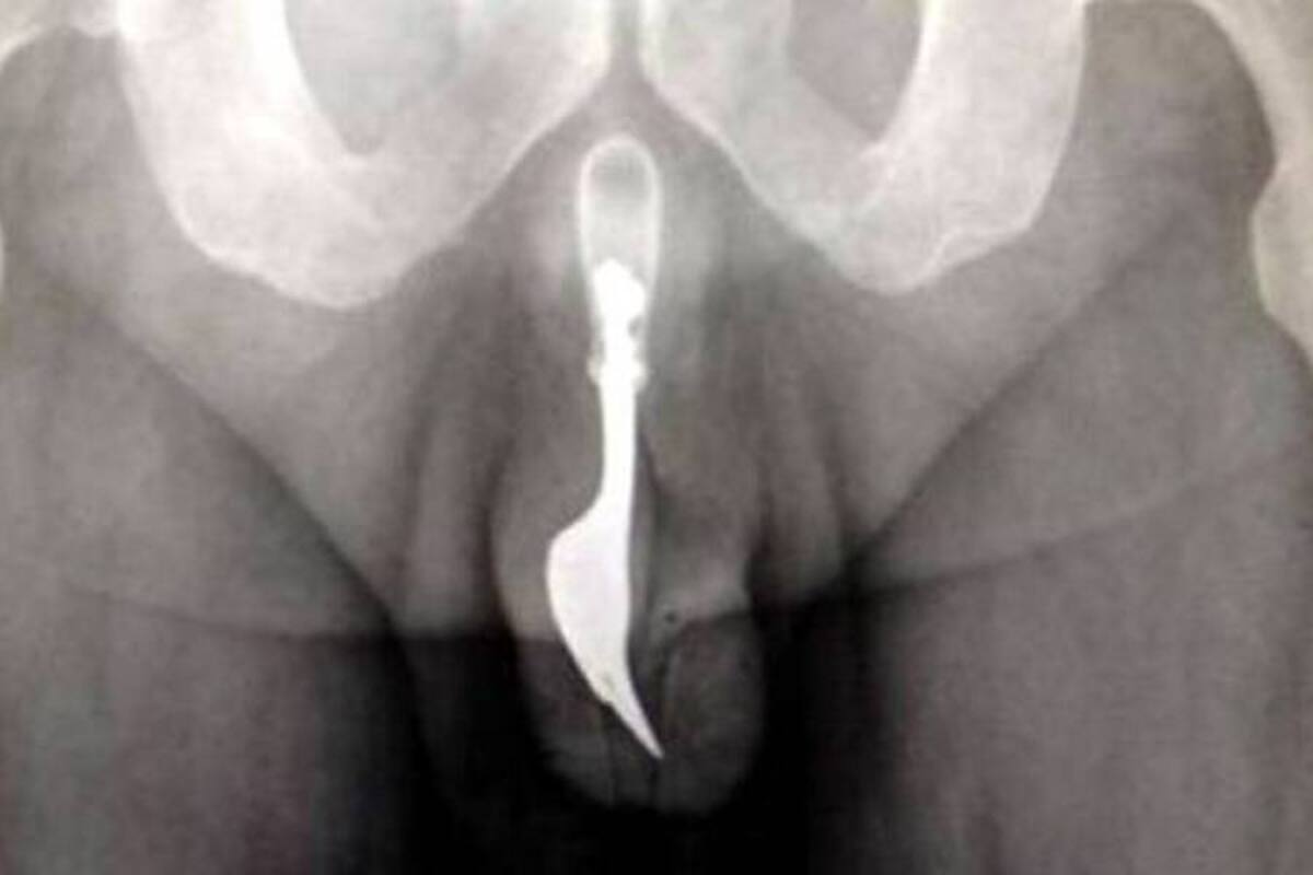 Australiano termina con tenedor dentro de su pene por juego sexual (Foto: Tomado de Internet/VANGUARDIA LIBERAL)