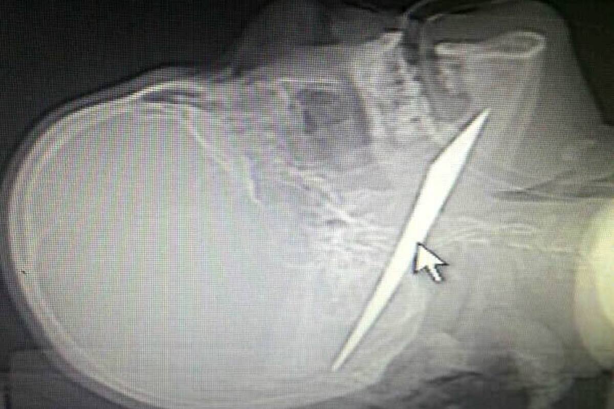 Entierran un cuchillo en la cabeza a un hombre en Barranquilla (Foto: Colprensa / VANGUARDIA LIBERAL)