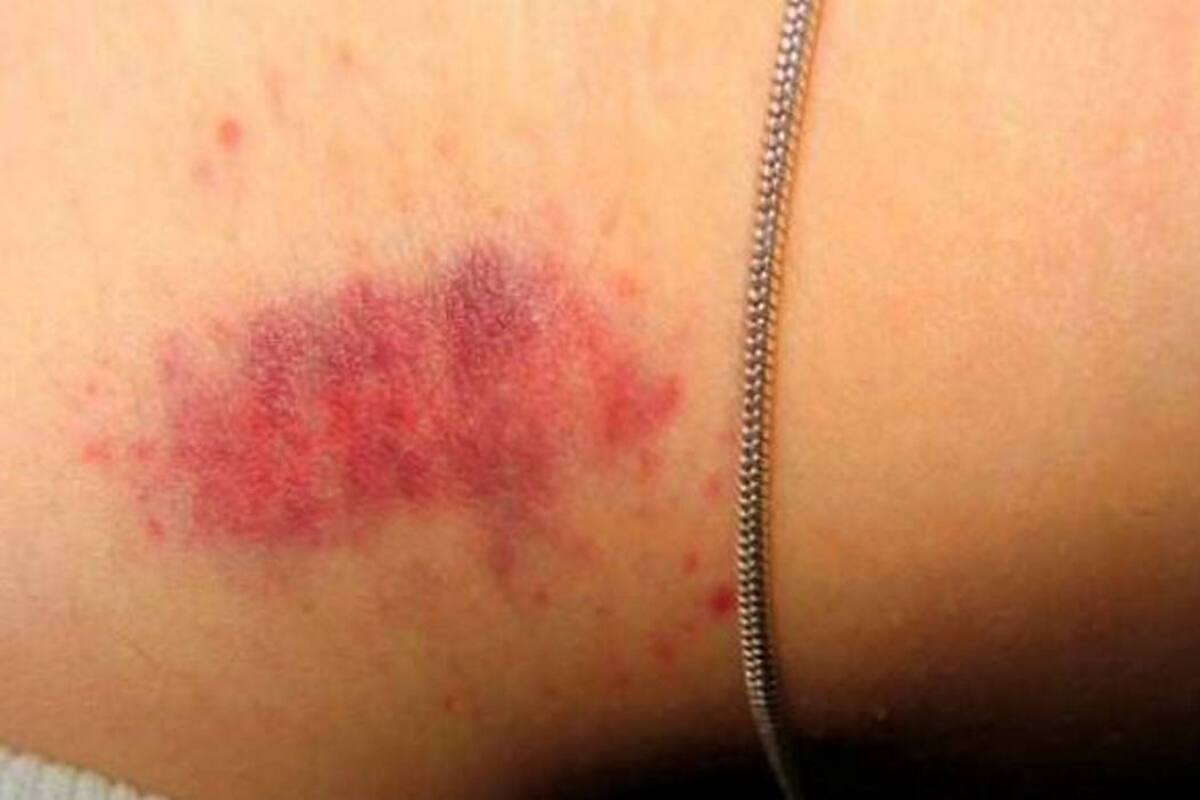 El hombre, de 17 años, falleció por un coágulo de sangre que se formó con esta clase beso. (Foto: Colprensa /VANGUARDIA LIBERAL)