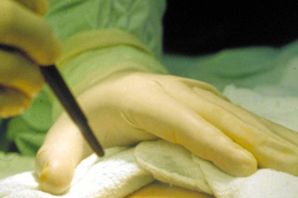 Nueva técnica podría reparar pulmones donados no aptos para trasplantar (Foto: Archivo/VANGUARDIA LIBERAL)