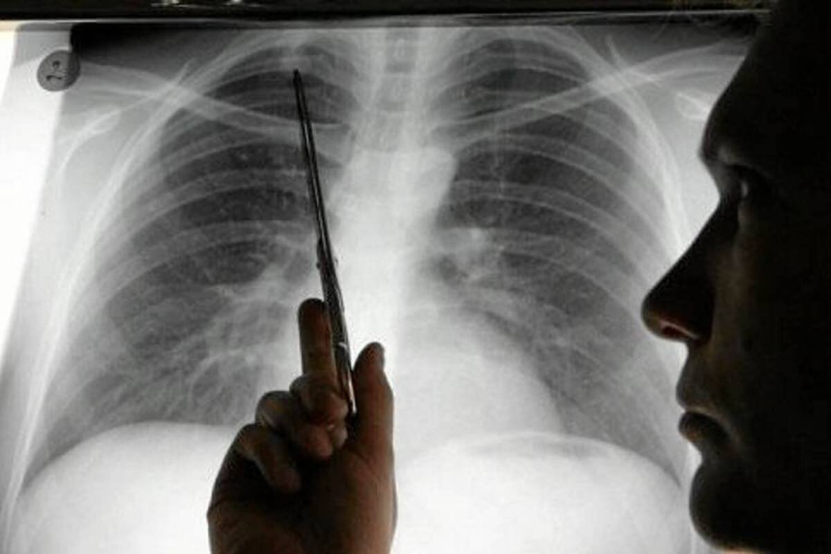Investigadores descubren una estrategia para prevenir la metástasis de pulmón (Foto: Archivo/VANGURDIA LIBERAL)