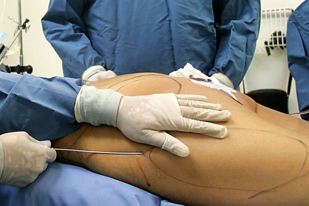 En riesgo la salud por intervenciones estéticas ilegales.(Foto: Colprensa /VANGUARDIA LIBERAL)