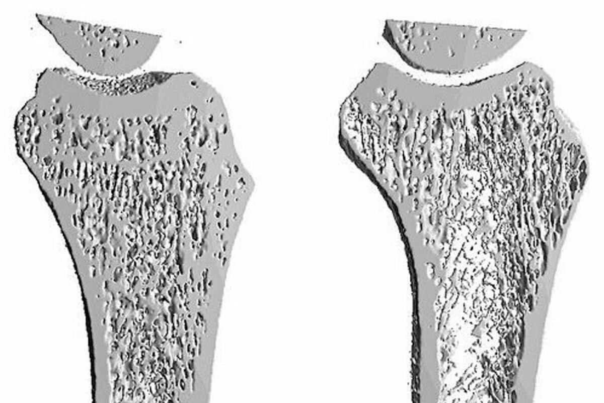 El envejecimiento de América Latina aumentará incidencia de osteoporosis (Foto: Tomado de Internet/ VANGUARDIA LIBERAL)