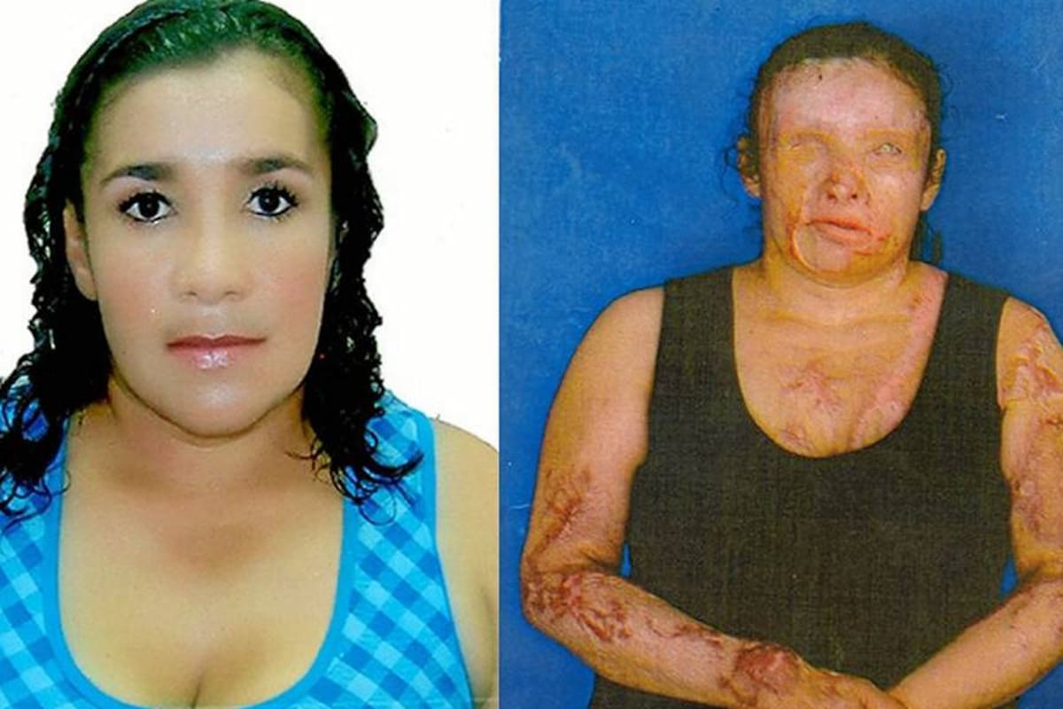 La fotos corresponden a Lucía Nubia Patricia Carreño Barrera, de 36 años. Antes y después de ser agredida con ácido. (Foto: Suministrada / VANGUARDIA LIBERAL)