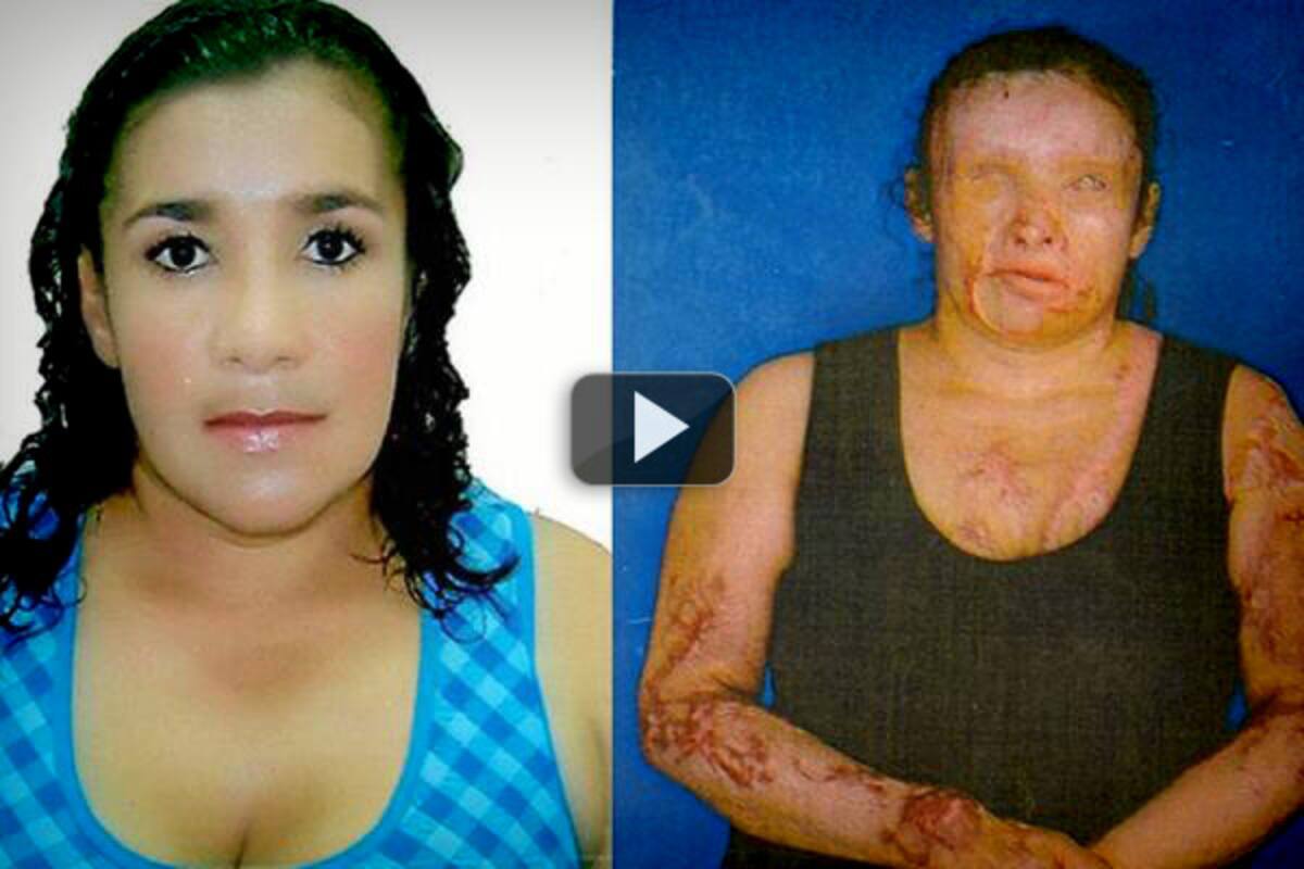 Mujer quemada con ácido en Girón contó en directo su historia (Foto: Archivo/VANGUARDIA LIBERAL)