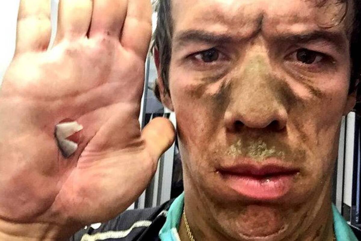 Así quedó Urán tras la dura prueba del pavé en el Tour