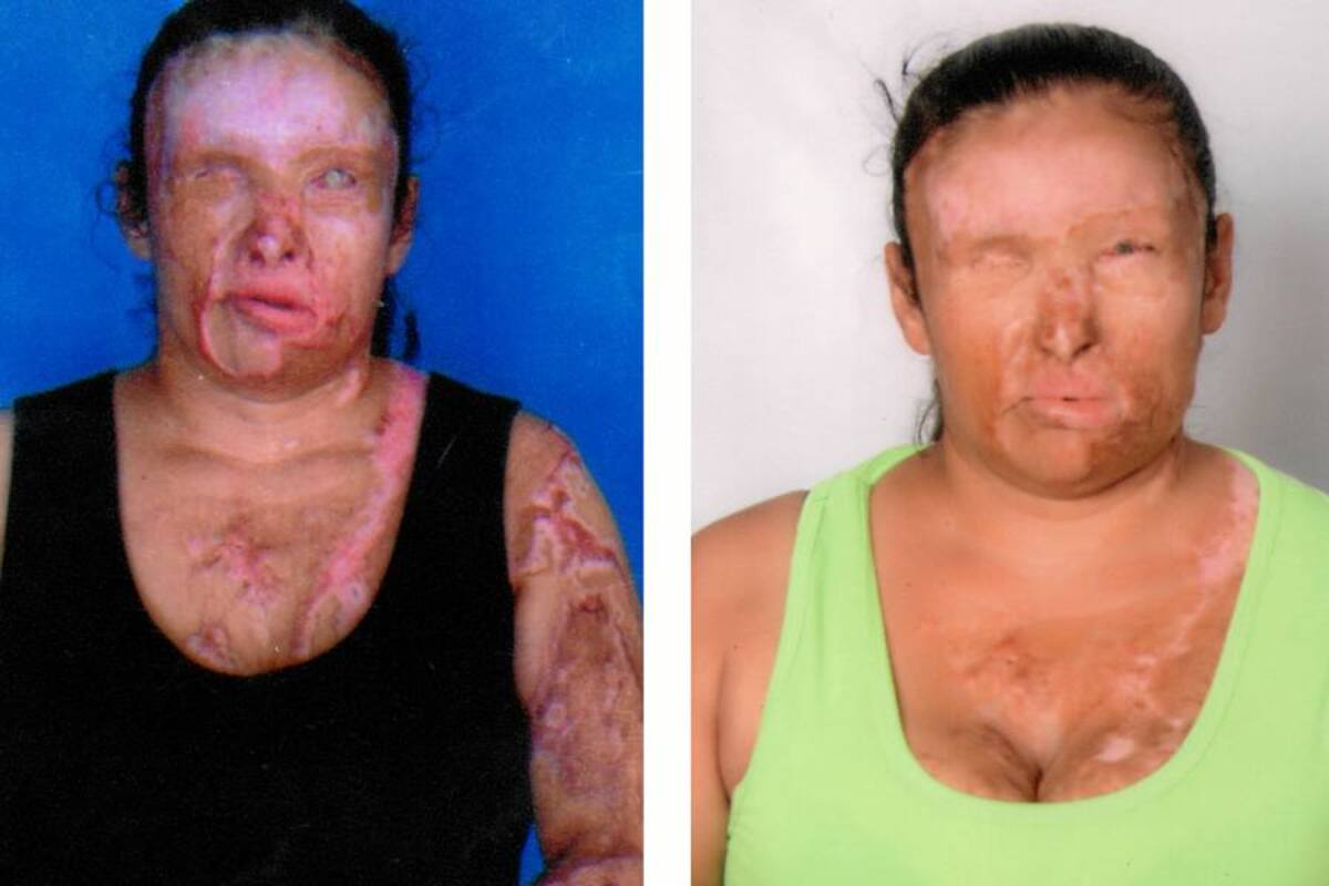 Mujer quemada con ácido en Girón se prepara para su cirugía número 21 (Foto: Foto Suministrada/VANGUARDIA LIBERAL)