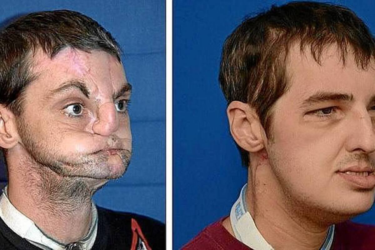 Lee Norris, el milagroso trasplante de cara (Foto: Archivo/VANGUARDIA LIBERAL)
