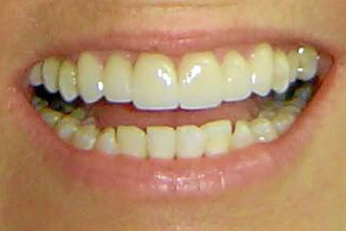 El riesgo de tener dientes extrablancos (Foto: Archivo/VANGUARDIA LIBERAL)