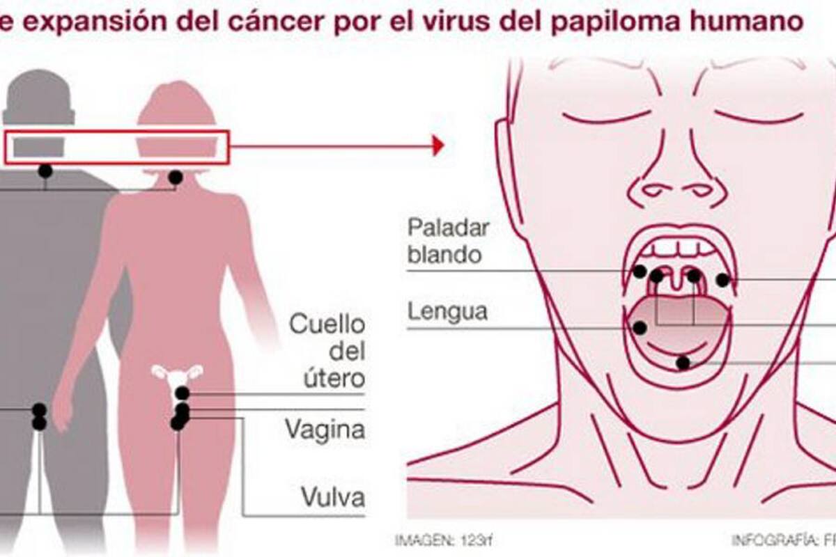 Científicos advierten sobre el avance “epidémico” del cáncer bucal por sexo oral (Foto: tomado de noticias 24/VANGUARDIALIBERAL)