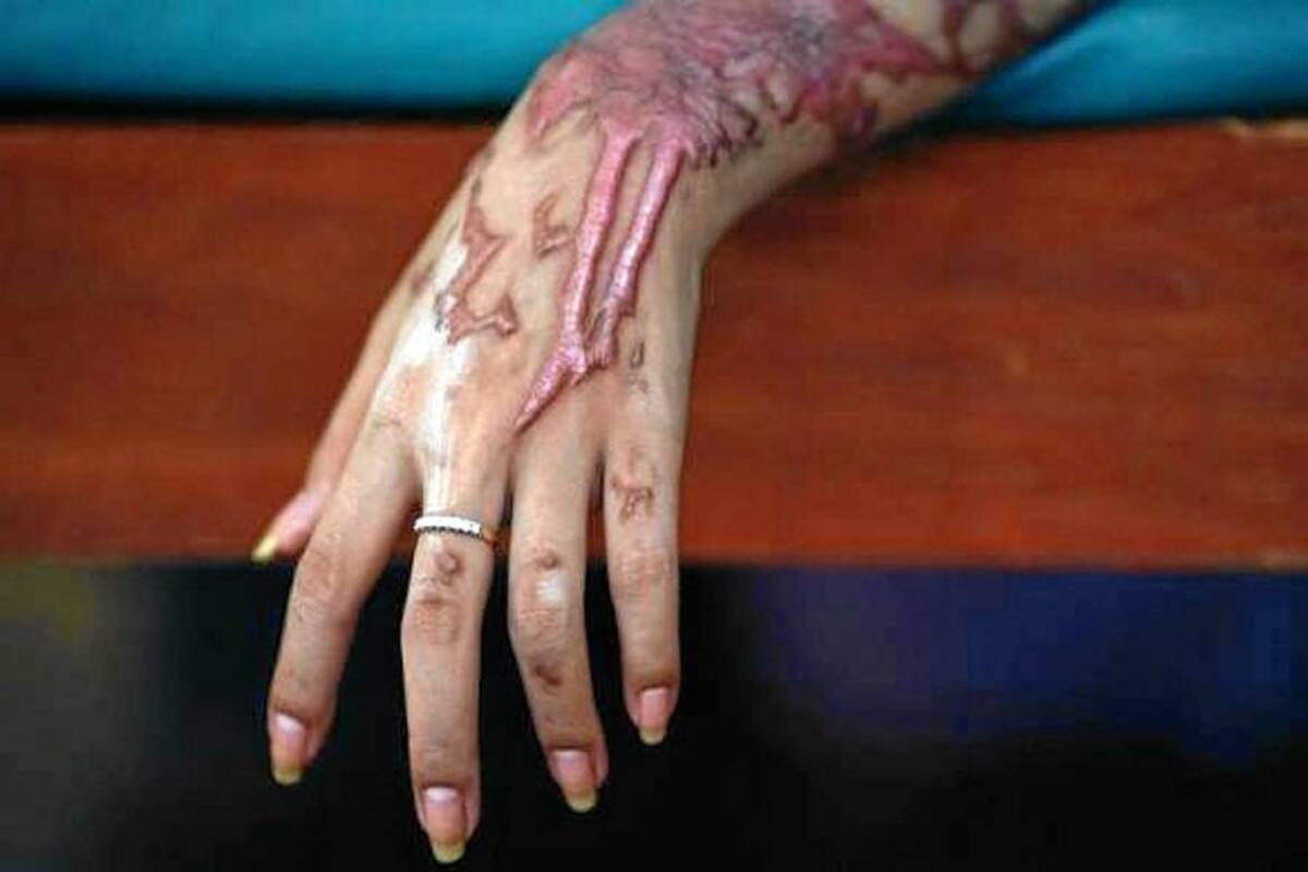 Secuelas del ácido son para toda la vida (Foto: Tomada de internet/VANGUARDIA.COM)